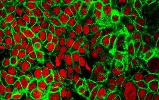 Human colon cancer cells with the cell nuclei stained red and the protein E-cadherin stained green.